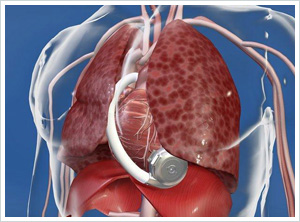 HW_HVAD-pump-in-pericardial-space_0.jpg